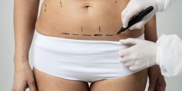 Lipoaspiração, minilipo, hidrolipo e lipo HD: entenda esses procedimentos