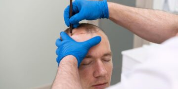 Transplante capilar: saiba como são os períodos pré e pós-operatório