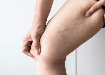 Tratamento de varizes sem cortes, tecnologia substitui cirurgia convencional