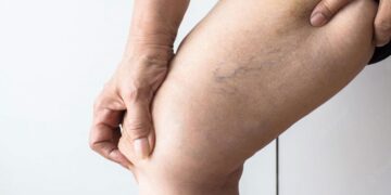 Tratamento de varizes sem cortes, tecnologia substitui cirurgia convencional