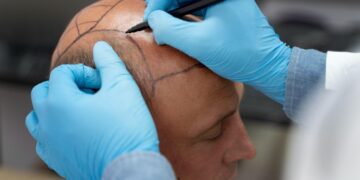 Transplante capilar: entenda o procedimento e conheça as técnicas utilizadas