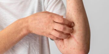 Doenças alérgicas: saiba o que são e entenda como diagnosticá-las e tratá-las