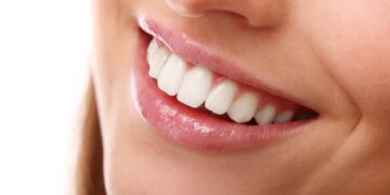 Facetas de Resina Composta: sorriso bonito e duradouro
